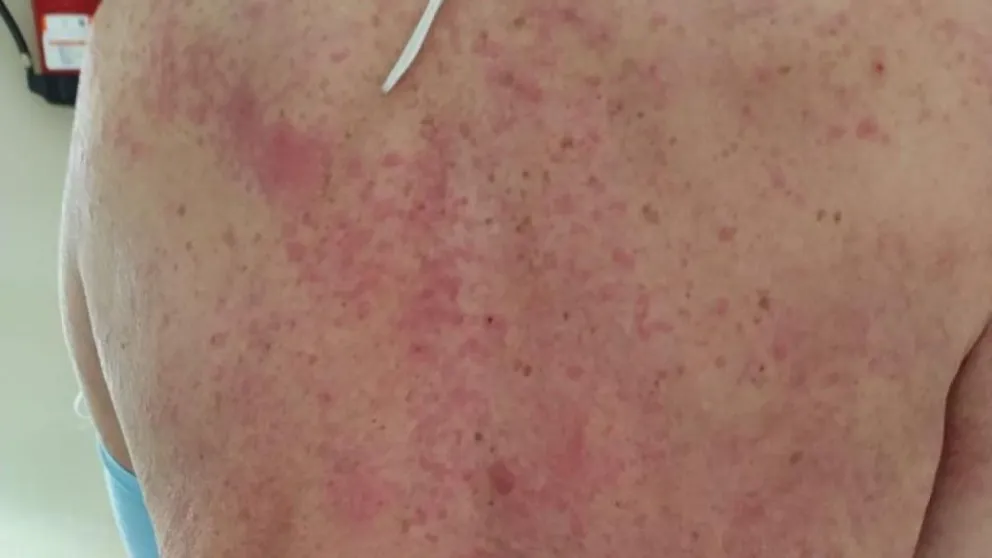 covidpiel