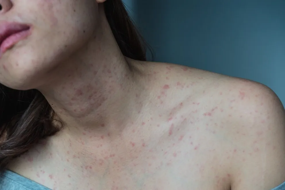 Dermatitis