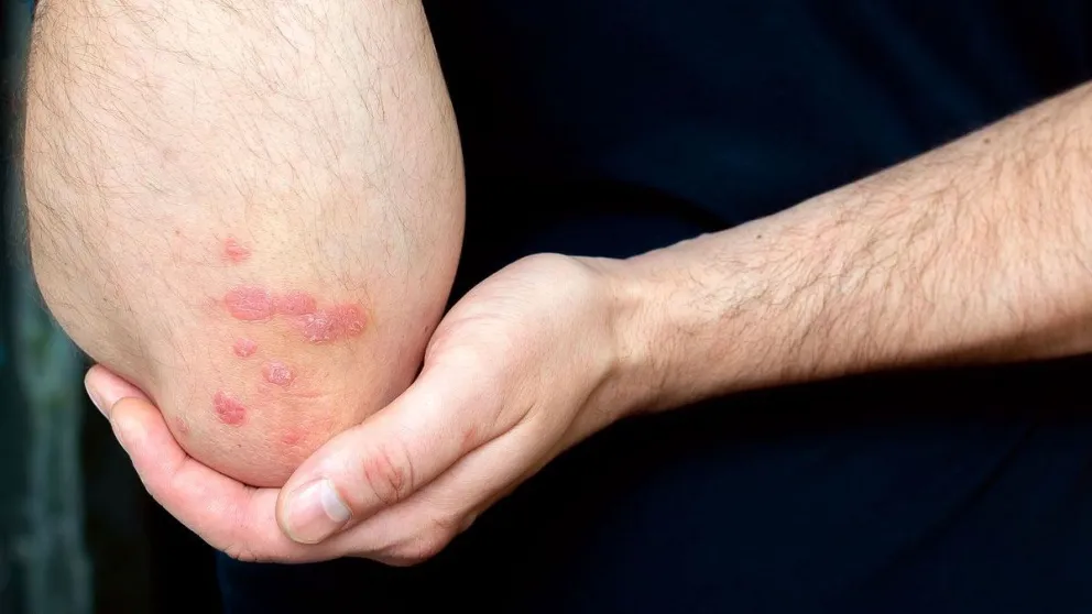 psoriasis