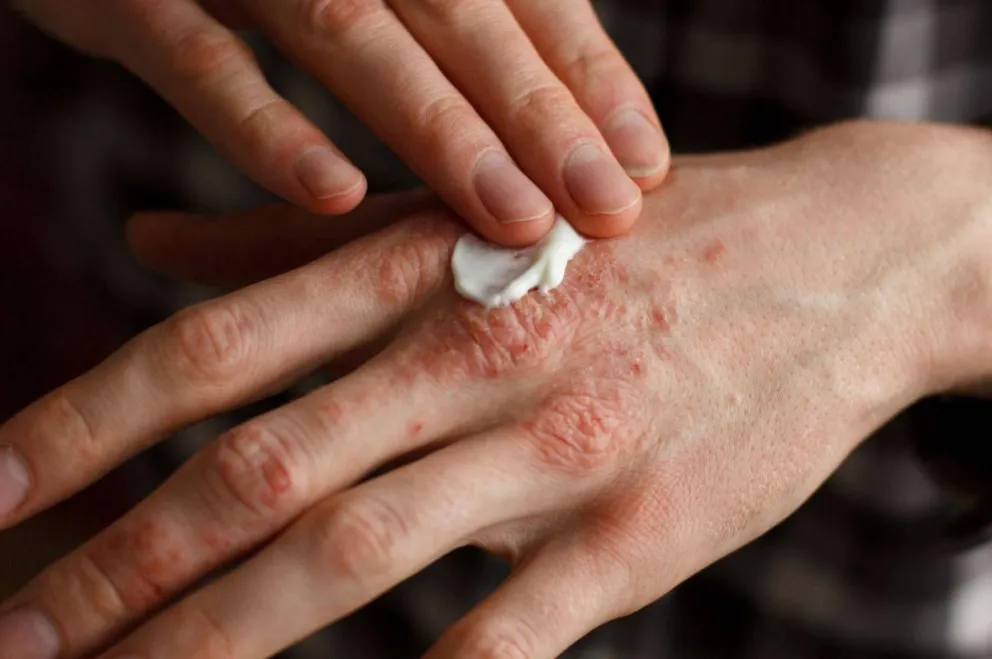 psoriasis