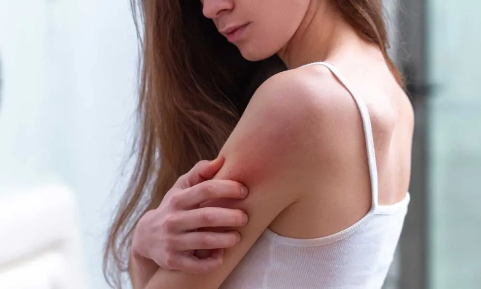 psoriasis