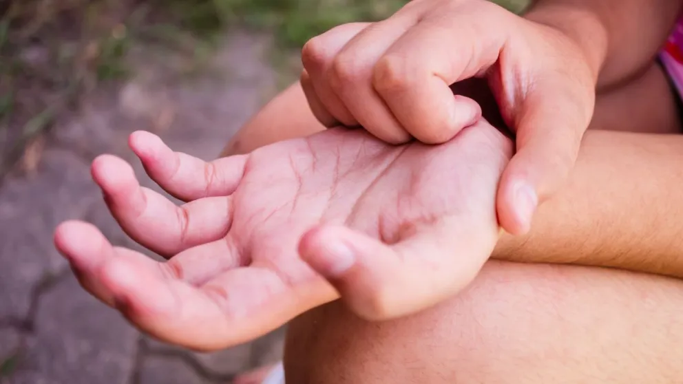 Dermatitis-atopica