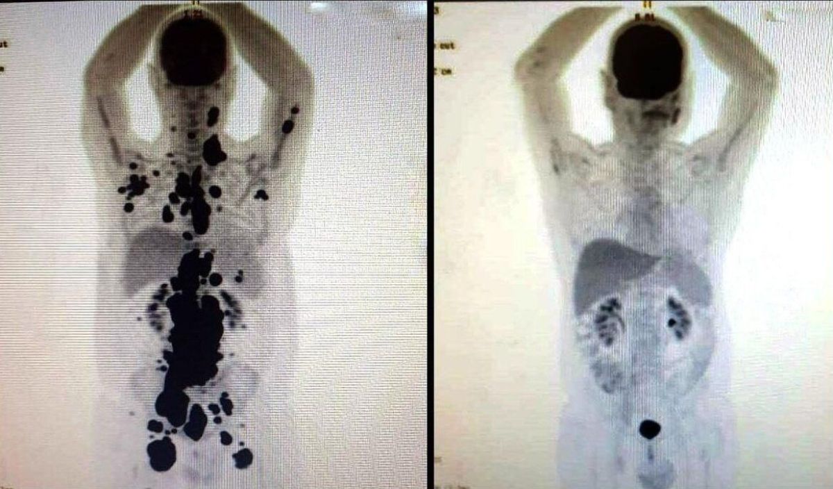 cáncer