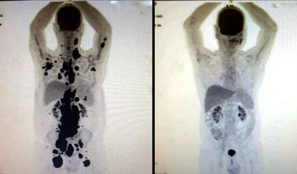 cancer-f