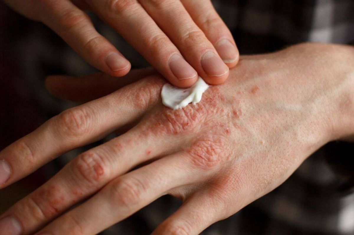 psoriasis