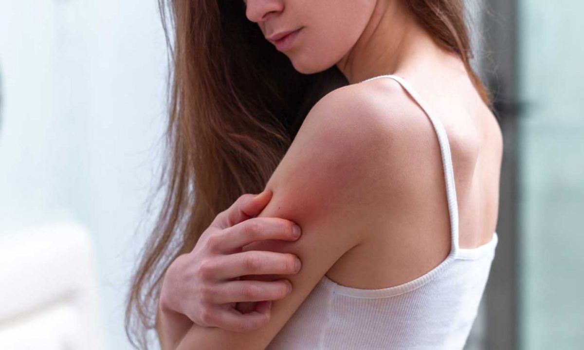 psoriasis